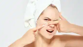 Sivilce İzleri Nasıl Geçer