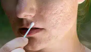 Sivilce Peelingi Nasıl Yapılır